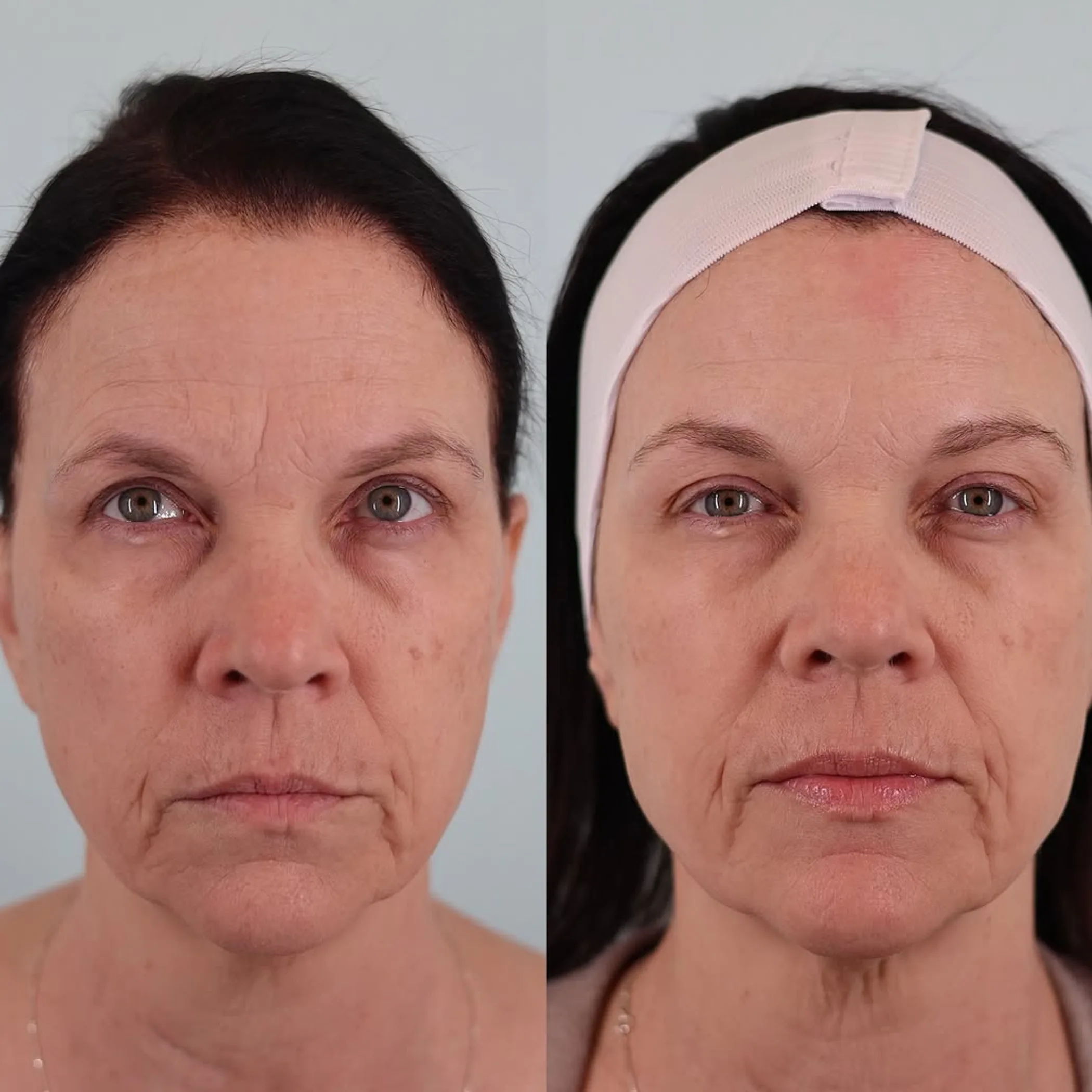 before-and-after facial treatment photos