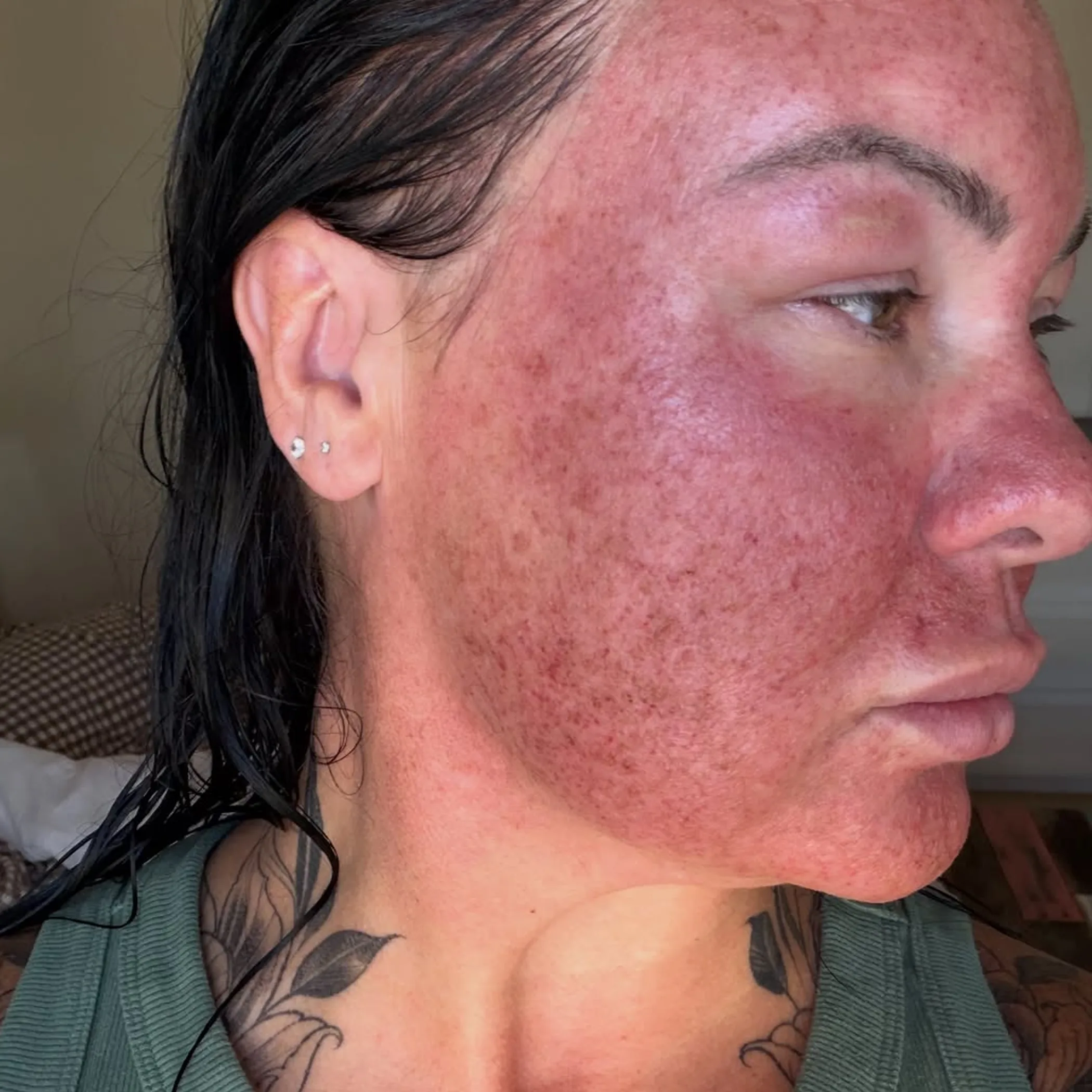 realistic co₂ laser recovery skin changes